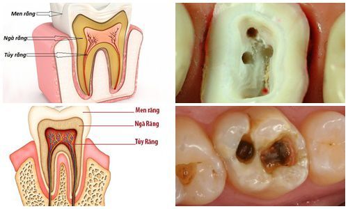 Điều Trị Nội Nha, Viêm Tủy Răng Điều trị nội nha, chữa tủy răng là gì?