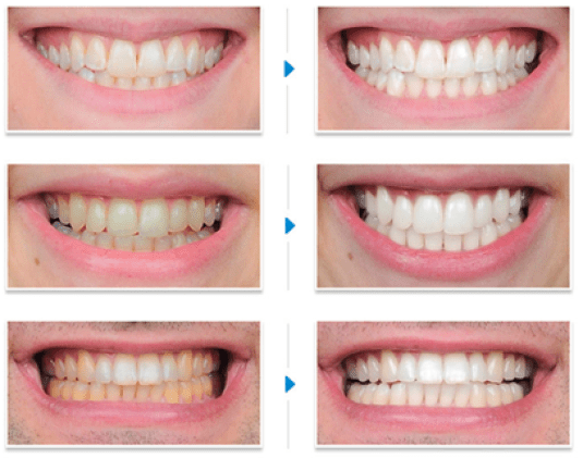 5 cách tẩy trắng răng