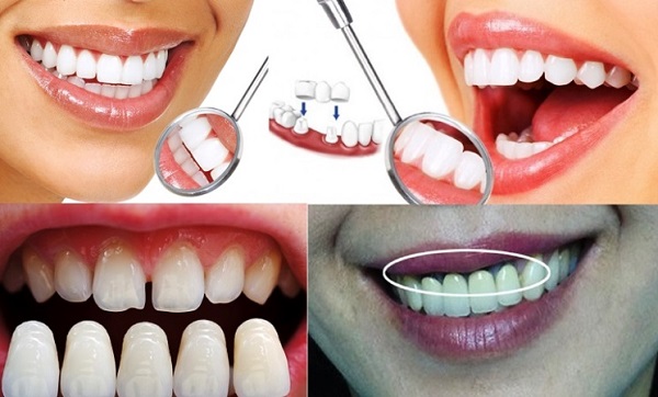 Răng bọc sứ cũng cần chăm sóc chu đáo như răng tự nhiên