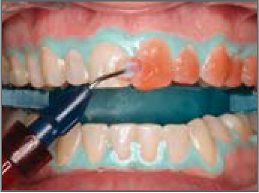 tẩy trắng răng tại phòng mạch bằng Opalescence boost